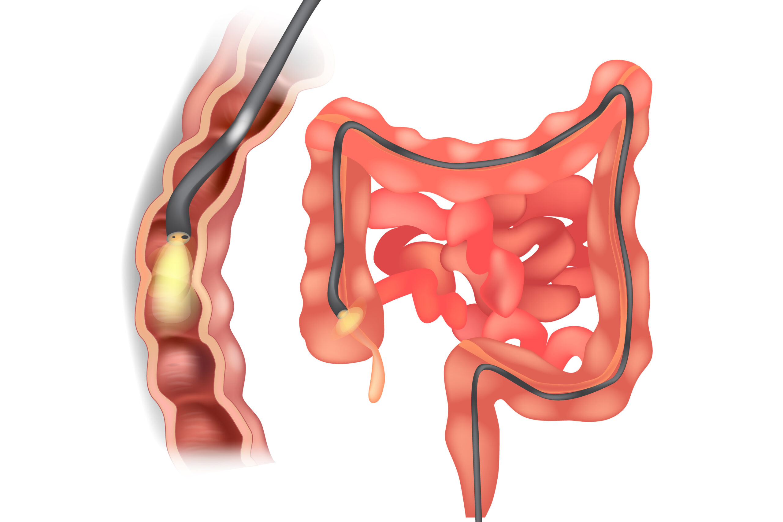 内視鏡検査 大腸カメラ