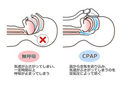 CPAP療法の様子